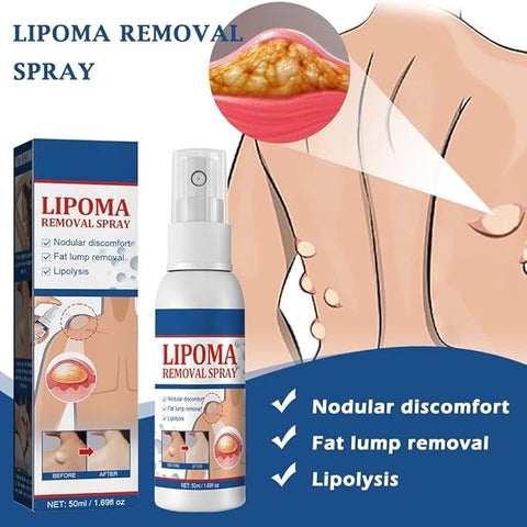 LIPOMA REMOVAL SPRAY / CREAM