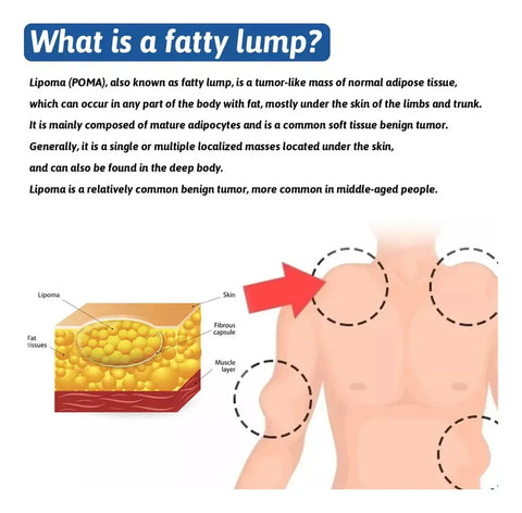 LIPOMA REMOVAL SPRAY / CREAM