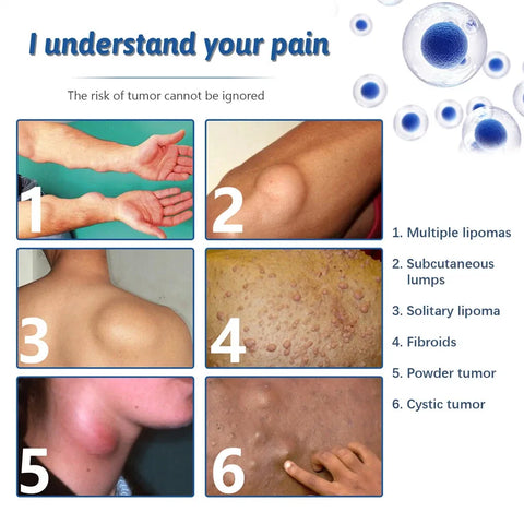 LIPOMA REMOVAL SPRAY / CREAM