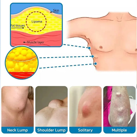 LIPOMA REMOVAL SPRAY / CREAM